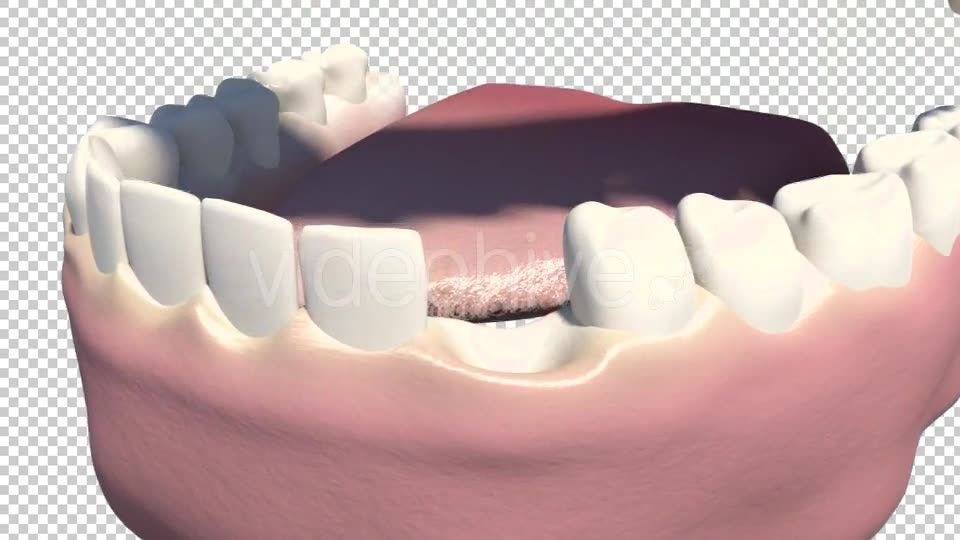 Dental Implants Videohive 19245111 Motion Graphics Image 2