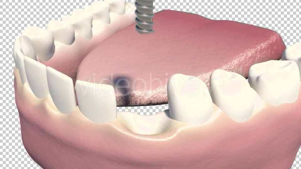 Dental Implants Videohive 19245111 Motion Graphics Image 4