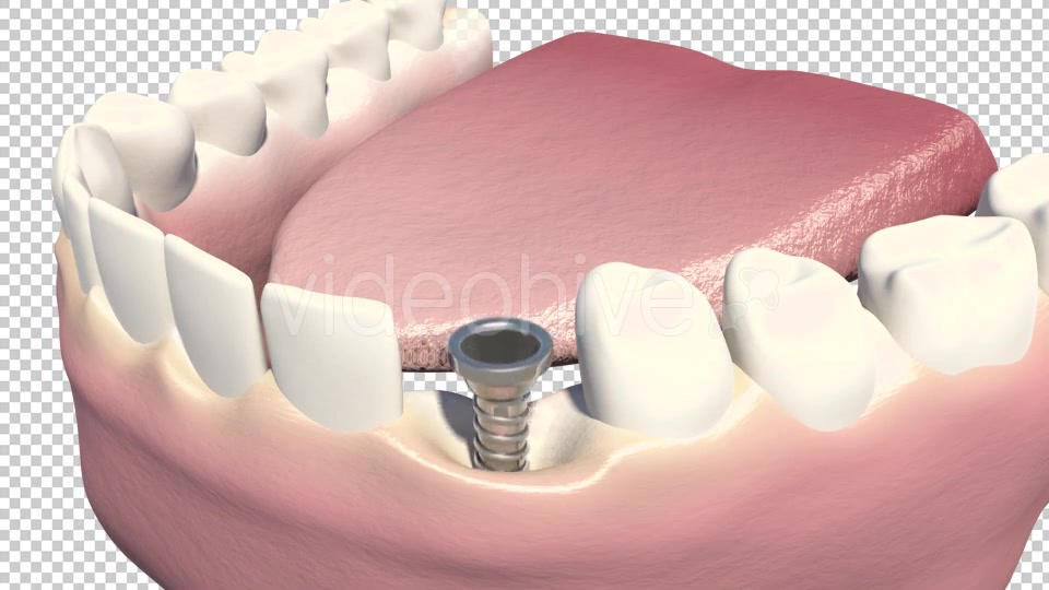 Dental Implants Videohive 19245111 Motion Graphics Image 5