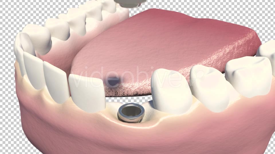 Dental Implants Videohive 19245111 Motion Graphics Image 6