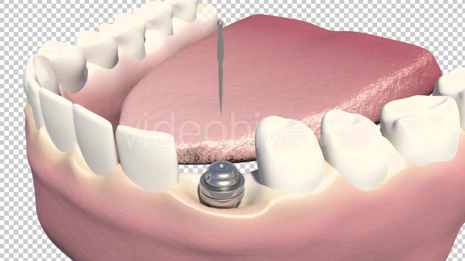 Dental Implants Videohive 19245111 Motion Graphics Image 8