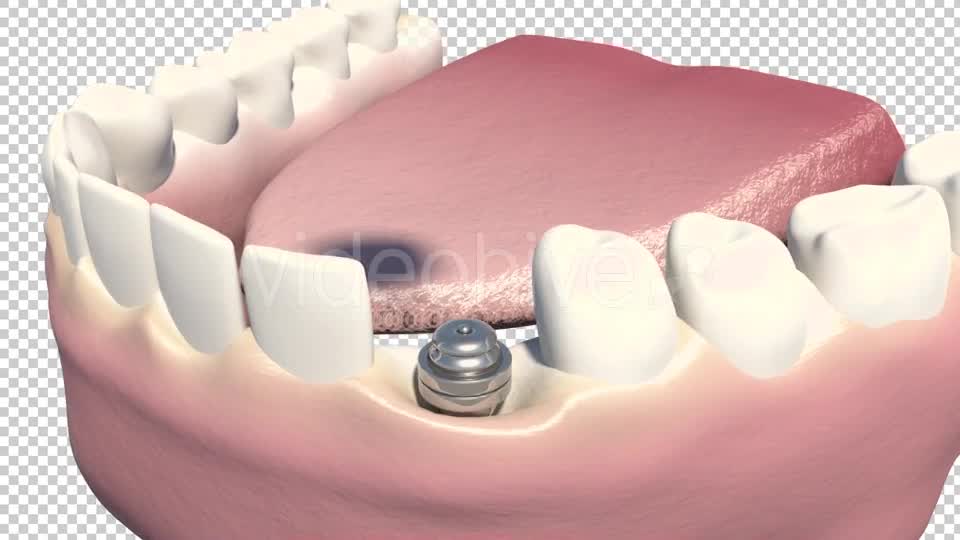Dental Implants Videohive 19245111 Motion Graphics Image 9