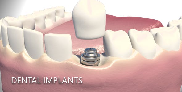 Dental Implants - Videohive 19245111 Download