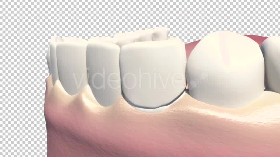 Dental Veneers Videohive 19247397 Motion Graphics Image 10