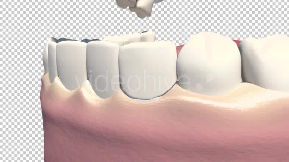Dental Veneers Videohive 19247397 Motion Graphics Image 11