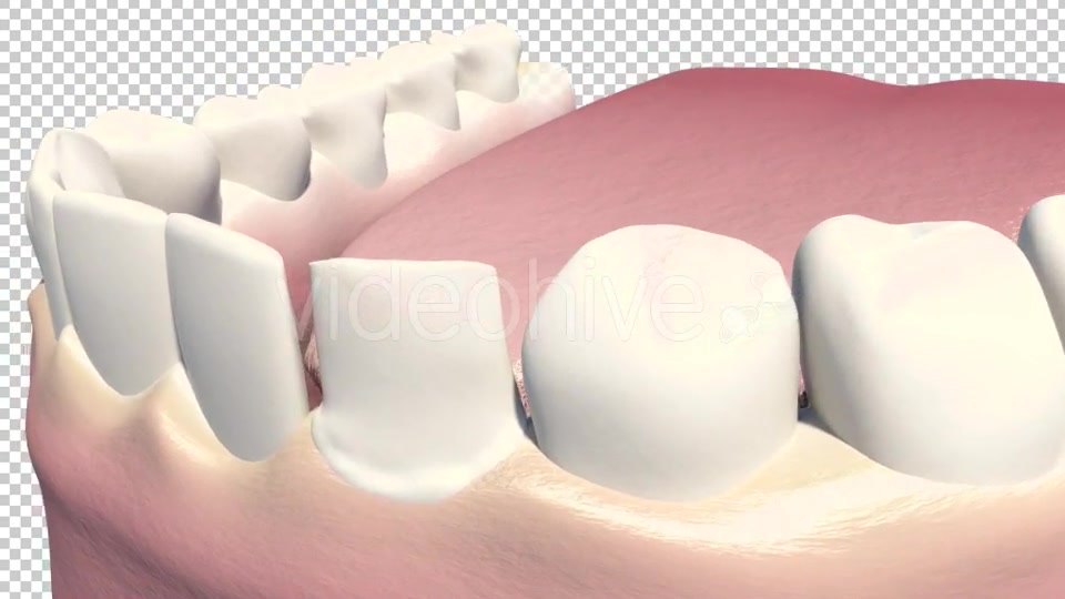 Dental Veneers Videohive 19247397 Motion Graphics Image 4