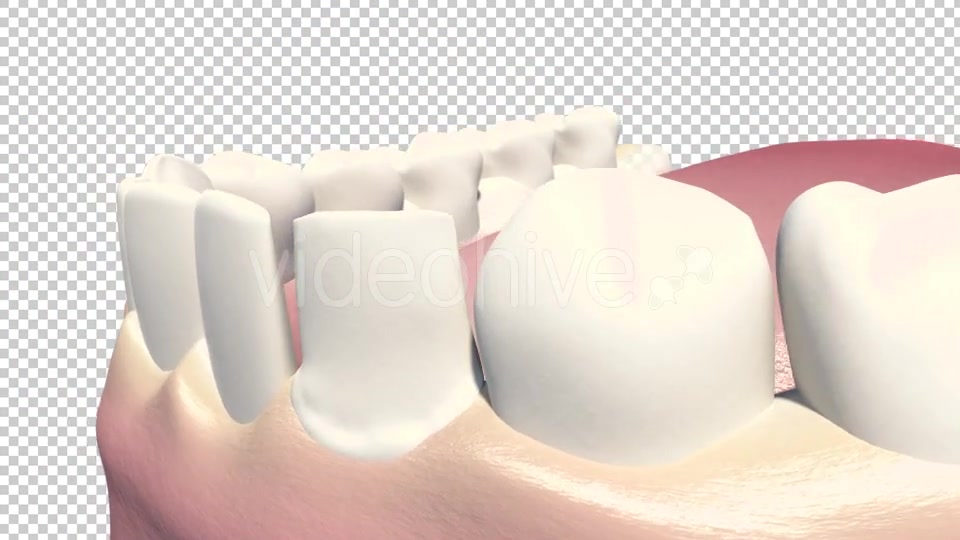 Dental Veneers Videohive 19247397 Motion Graphics Image 5