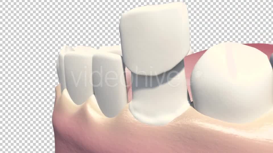 Dental Veneers Videohive 19247397 Motion Graphics Image 9