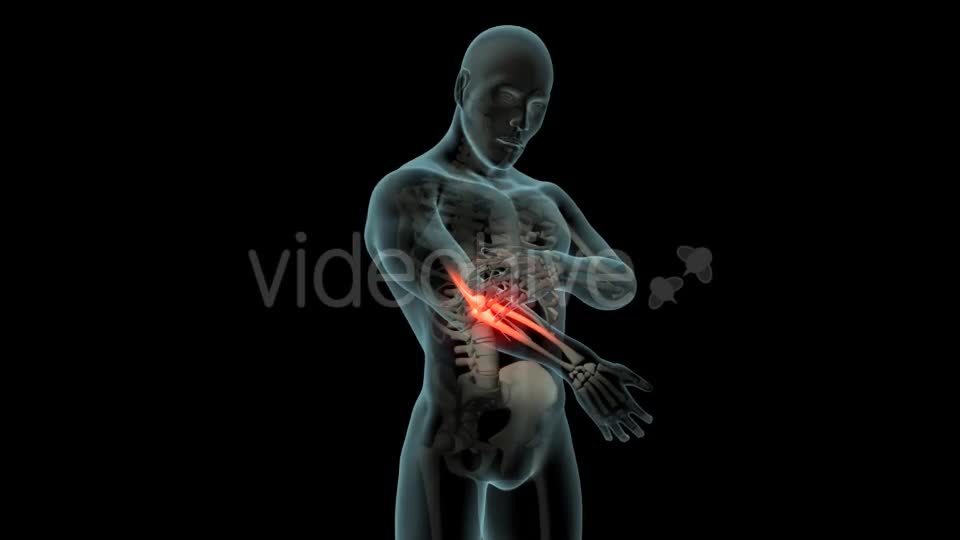 Elbow Pain Videohive 21253430 Motion Graphics Image 1