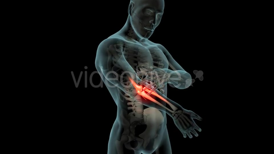 Elbow Pain Videohive 21253430 Motion Graphics Image 3