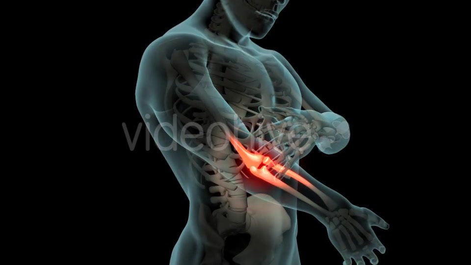 Elbow Pain Videohive 21253430 Motion Graphics Image 5