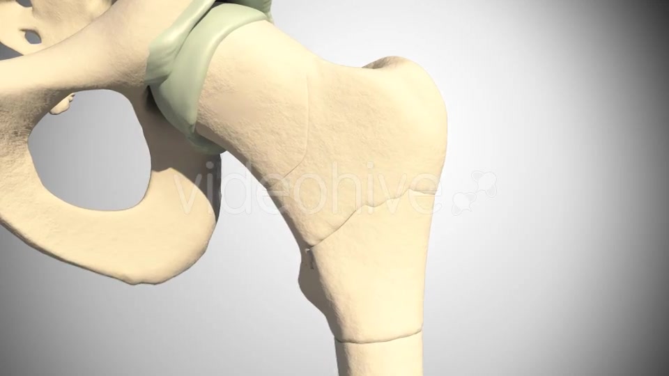 Fracture Femur Videohive 14920493 Motion Graphics Image 5