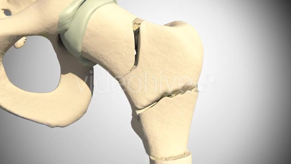 Fracture Femur Videohive 14920493 Motion Graphics Image 6