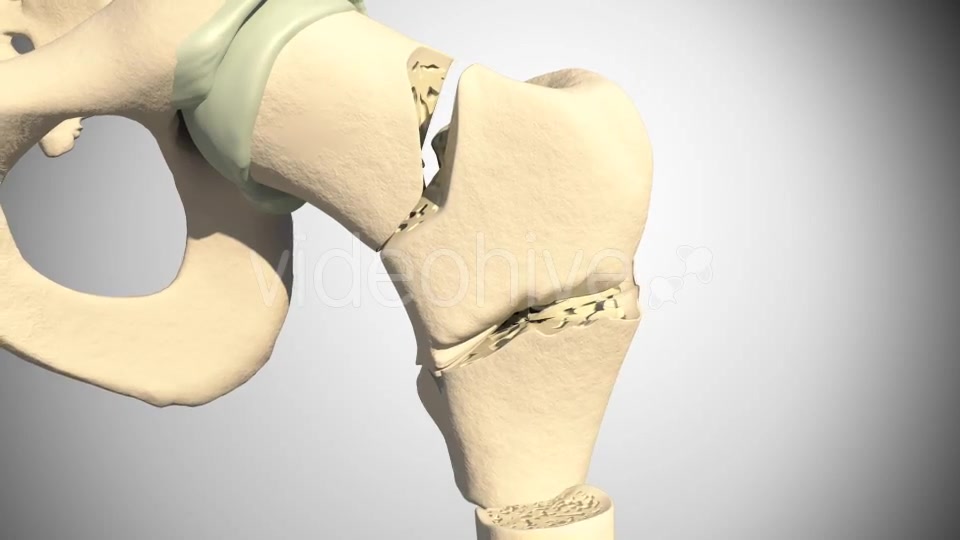 Fracture Femur Videohive 14920493 Motion Graphics Image 7