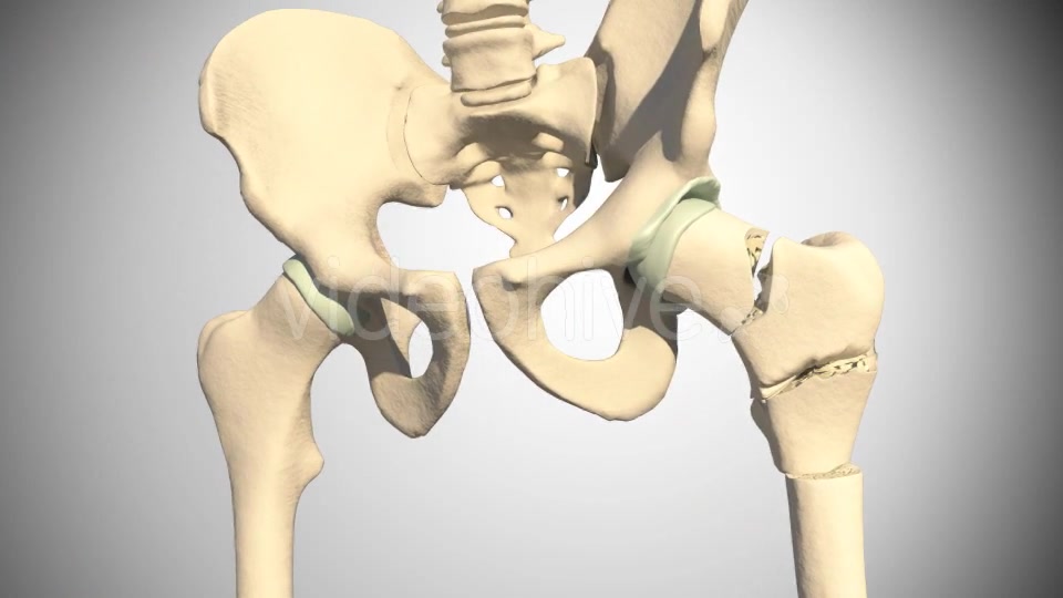 Fracture Femur Videohive 14920493 Motion Graphics Image 9