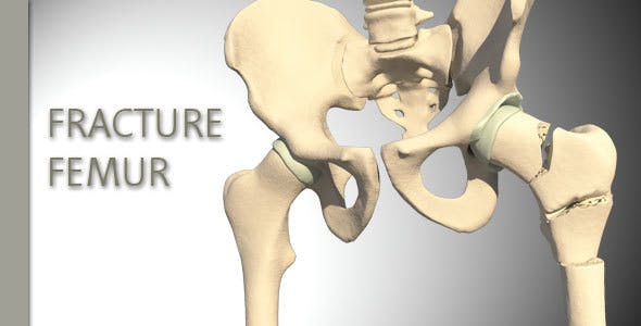 Fracture Femur - Download 14920493 Videohive