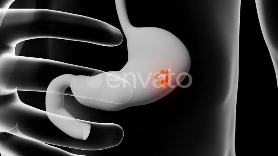 Gastric Ulcer Disease Videohive 21842950 Motion Graphics Image 2
