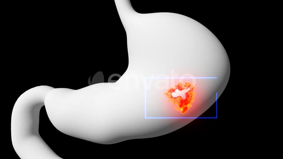 Gastric Ulcer Disease Videohive 21842950 Motion Graphics Image 3