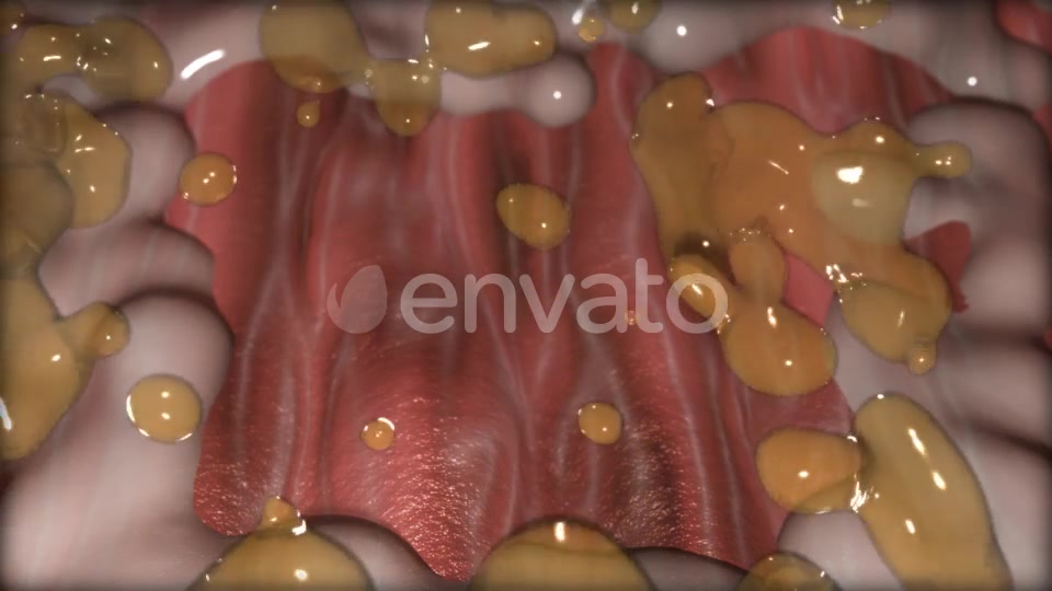 Gastric Ulcer Disease Videohive 21842950 Motion Graphics Image 7