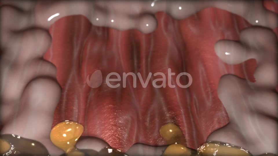 Gastric Ulcer Disease Videohive 21842950 Motion Graphics Image 8