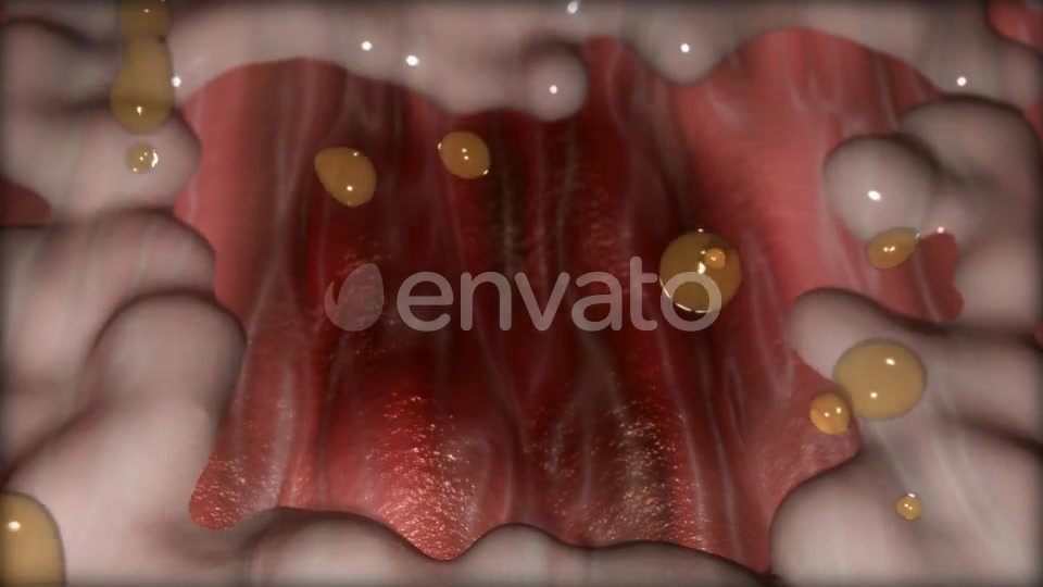 Gastric Ulcer Disease Videohive 21842950 Motion Graphics Image 9