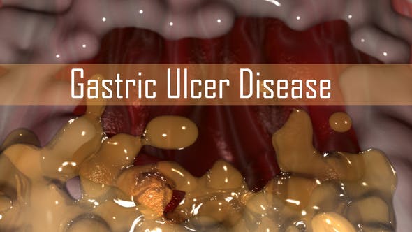 Gastric Ulcer Disease - Download 21842950 Videohive