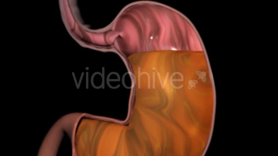 Gastroesophageal Reflux Videohive 20618472 Motion Graphics Image 1