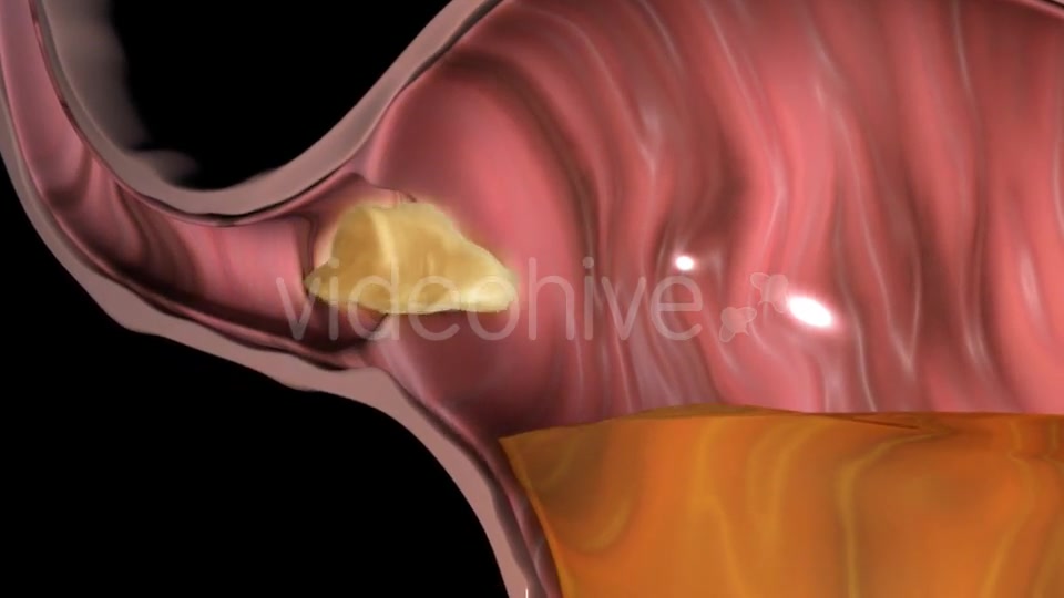 Gastroesophageal Reflux Videohive 20618472 Motion Graphics Image 3