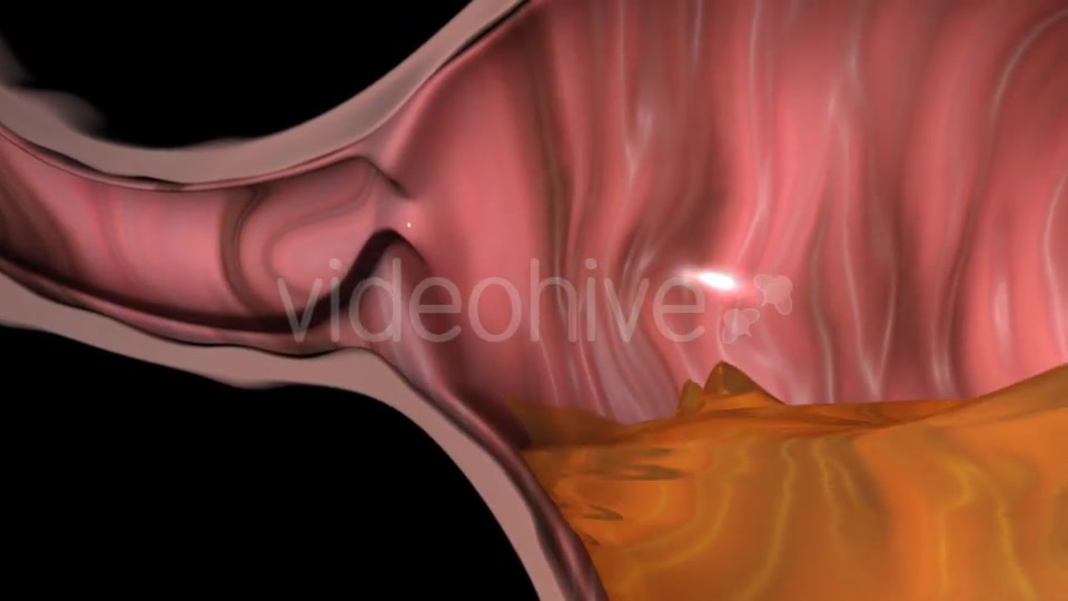Gastroesophageal Reflux Videohive 20618472 Motion Graphics Image 4