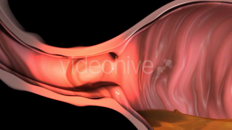 Gastroesophageal Reflux Videohive 20618472 Motion Graphics Image 5