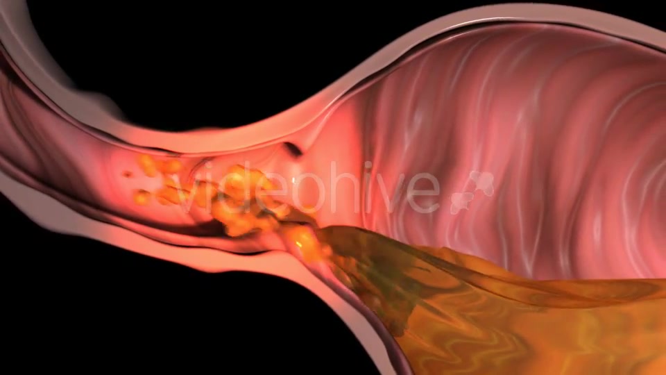 Gastroesophageal Reflux Videohive 20618472 Motion Graphics Image 6