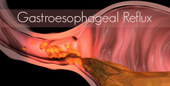 Gastroesophageal Reflux - 20618472 Videohive Download