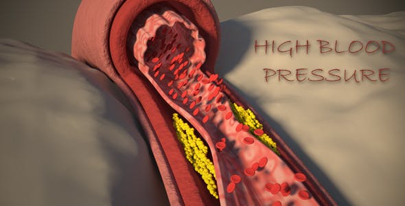 High Blood Pressure - Videohive Download 16180229