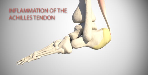 Inflammation Of The AchillesTendon - 16088922 Videohive Download