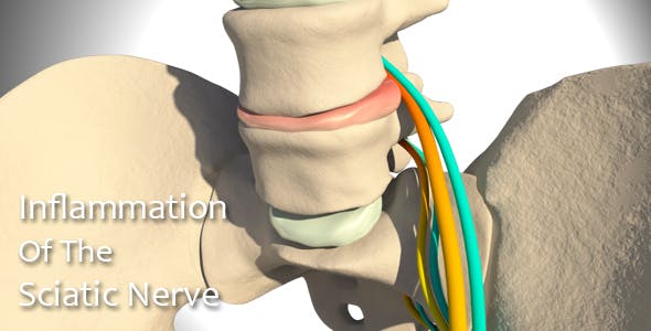 Inflammation Of The Sciatic Nerve - Videohive Download 14504287