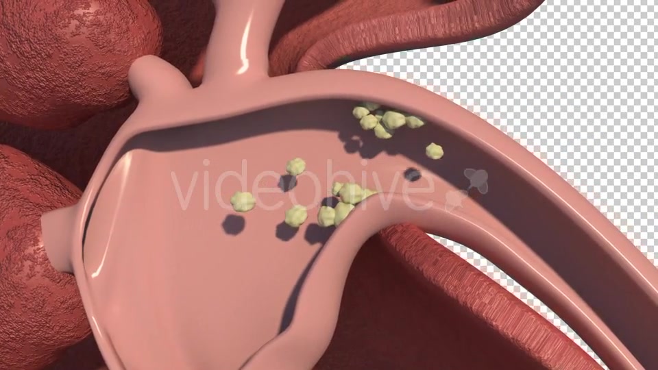 Kidney Stones Animation Videohive 19962852 Motion Graphics Image 6
