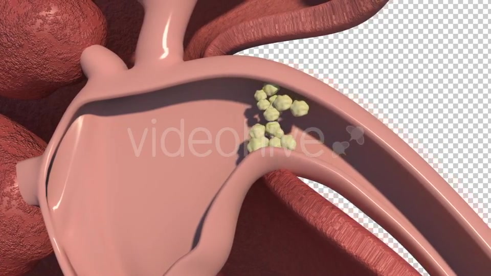 Kidney Stones Animation Videohive 19962852 Motion Graphics Image 7