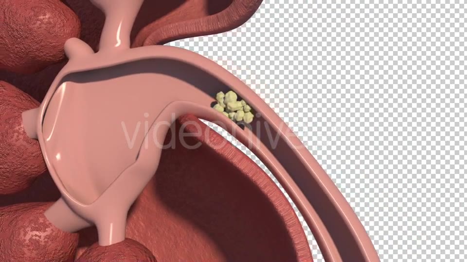 Kidney Stones Animation Videohive 19962852 Motion Graphics Image 8