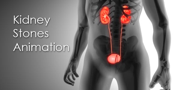 Kidney Stones Animation - Videohive Download 19962852