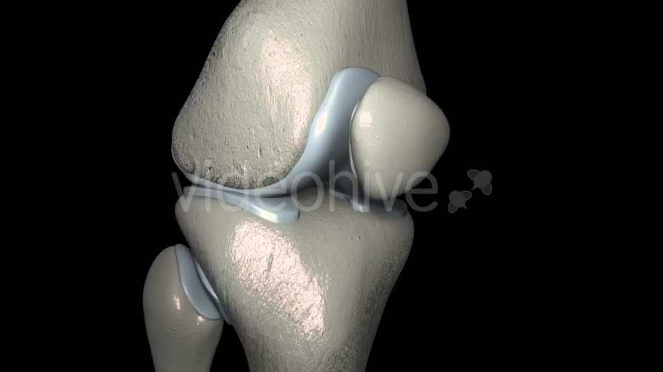 Knee Osteoarthritis With Osteophytes Videohive 21400790 Motion Graphics Image 1