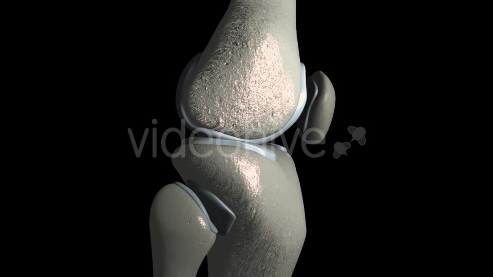 Knee Osteoarthritis With Osteophytes Videohive 21400790 Motion Graphics Image 2