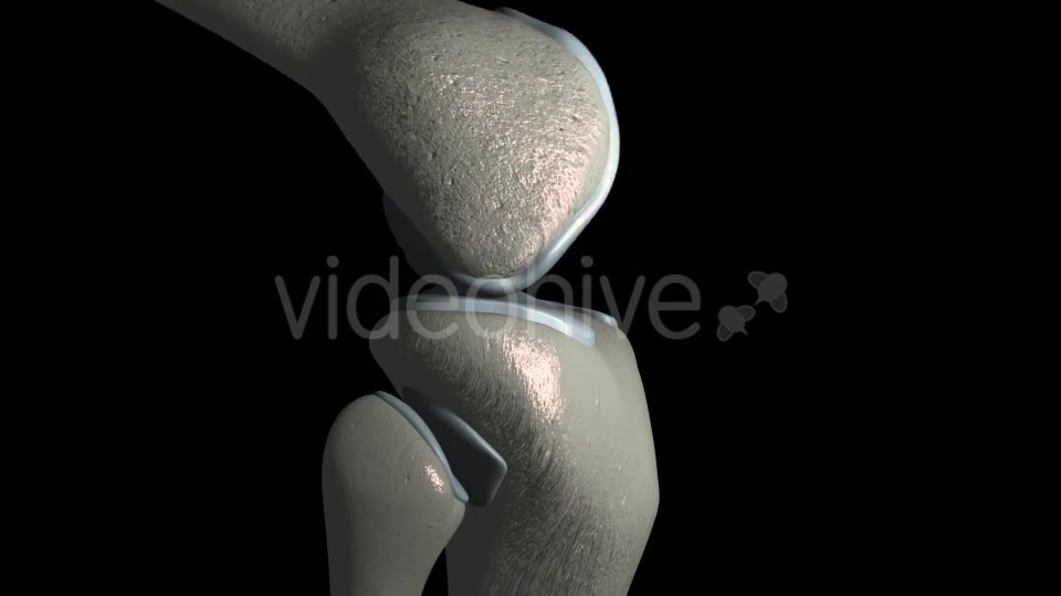 Knee Osteoarthritis With Osteophytes Videohive 21400790 Motion Graphics Image 3