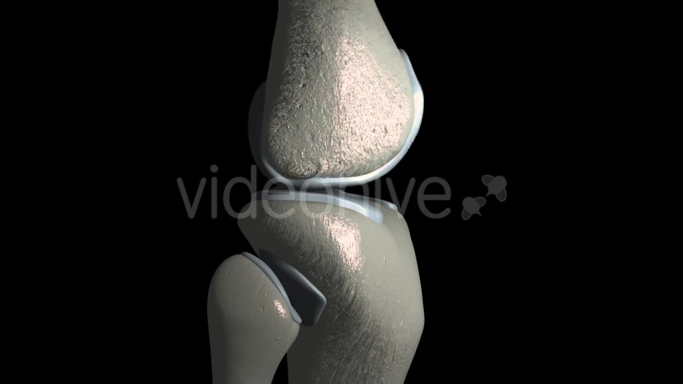 Knee Osteoarthritis With Osteophytes Videohive 21400790 Motion Graphics Image 4
