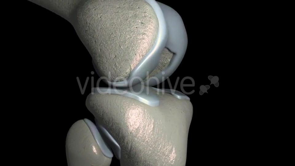 Knee Osteoarthritis With Osteophytes Videohive 21400790 Motion Graphics Image 5