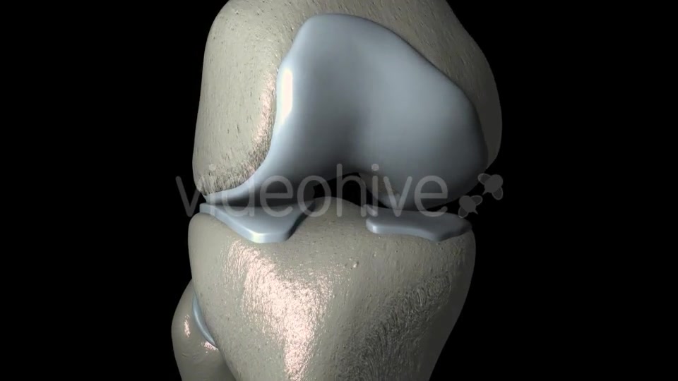 Knee Osteoarthritis With Osteophytes Videohive 21400790 Motion Graphics Image 6