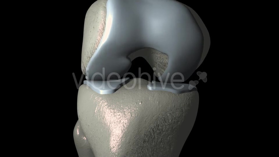Knee Osteoarthritis With Osteophytes Videohive 21400790 Motion Graphics Image 7