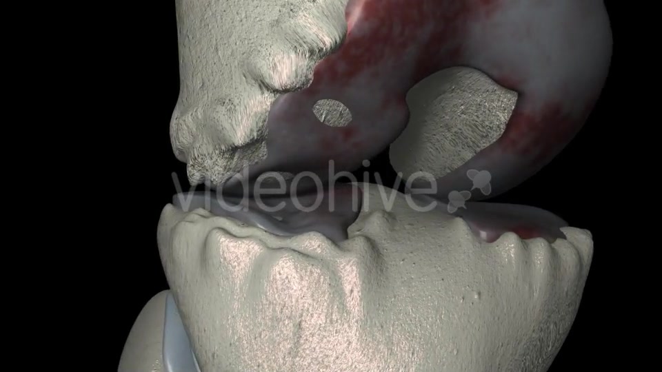 Knee Osteoarthritis With Osteophytes Videohive 21400790 Motion Graphics Image 8