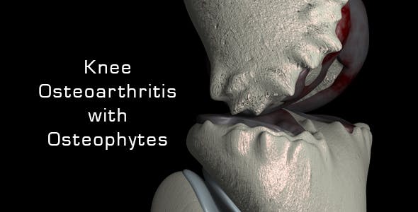 Knee Osteoarthritis With Osteophytes - 21400790 Videohive Download
