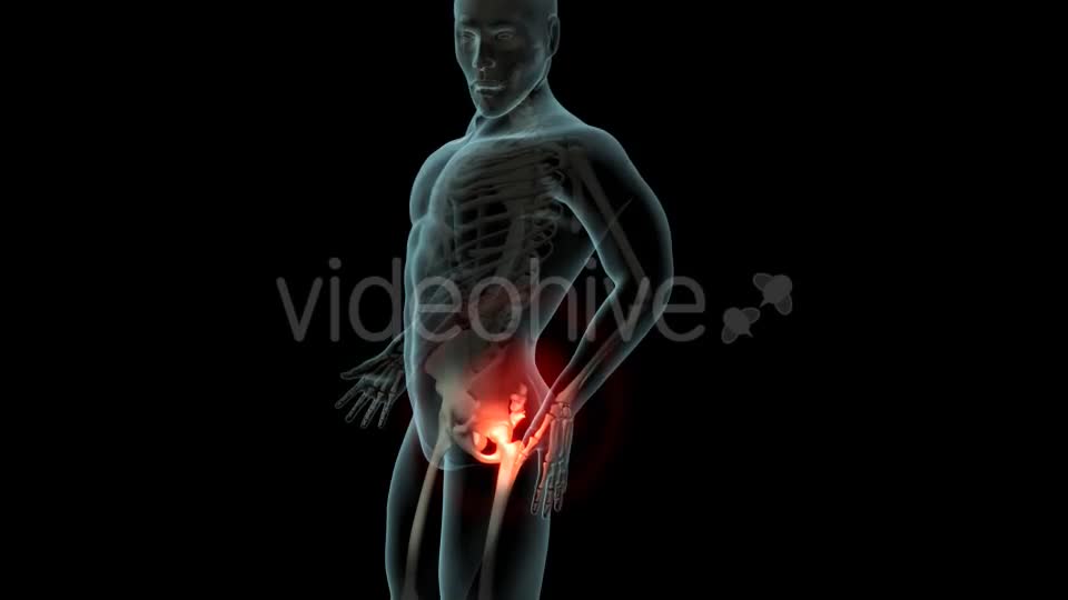 Lateral Hip Pain Videohive 21246229 Motion Graphics Image 1