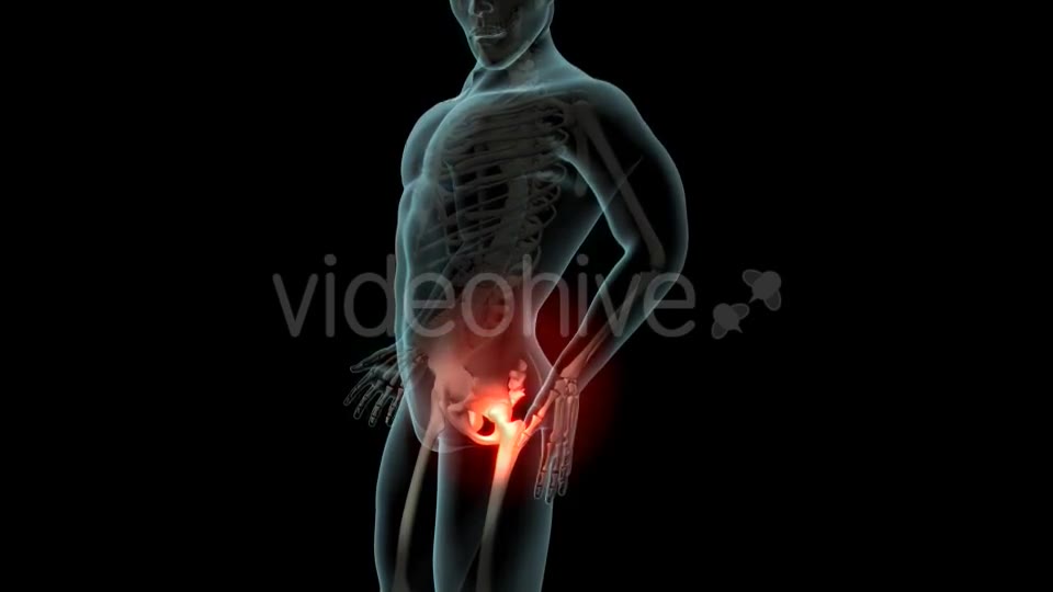 Lateral Hip Pain Videohive 21246229 Motion Graphics Image 2